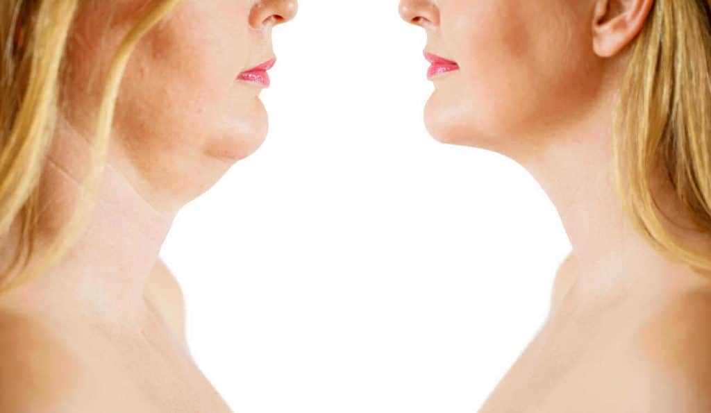 Double Chin treatment West Acton before and after results