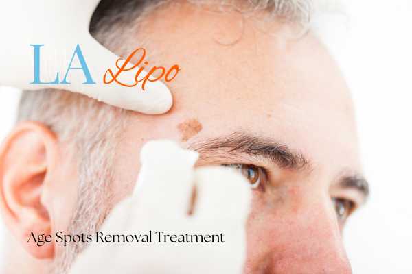 What Are the Most Effective Treatments for Age Spots West Acton?
