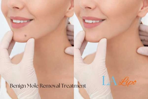 woman's before and after mole removal West Acton results