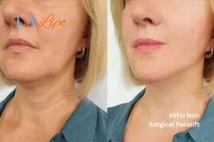 hi-fu for wrinkles West Acton before and after results