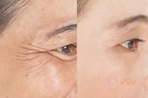 Before and after results of woman - HI-fu wrinkles reduction treatment West Acton