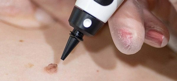 skin tag removal using cryopen West Acton