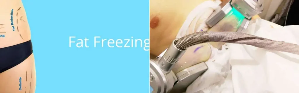 Fat freezing West Acton on multiple areas of the body