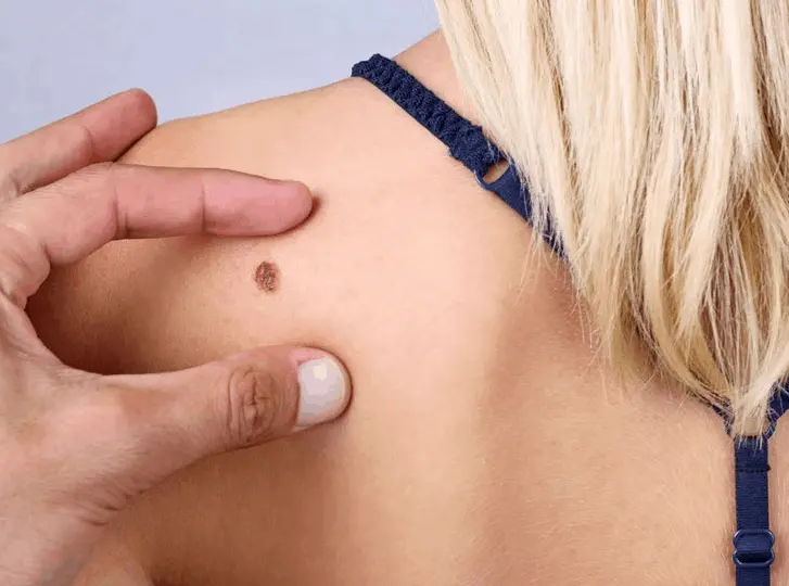 woman having mole removal West Acton consultation before treatment.