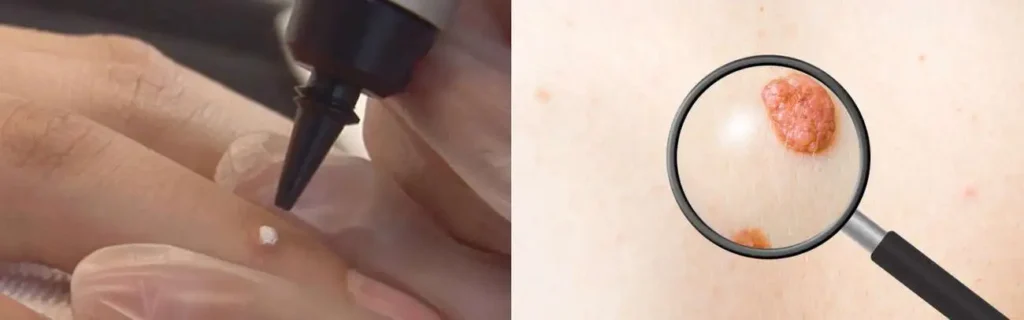 Cryopen for mole removal West Acton - speak to our team today!