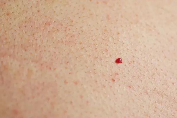 close up of a cherry angioma West Acton