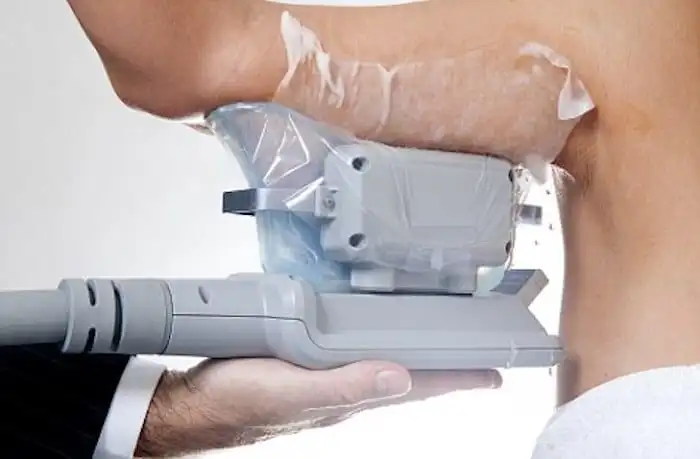 Picture of fat freezing West Acton on the upper arms.