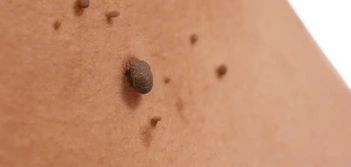 image of a skin tag West Acton