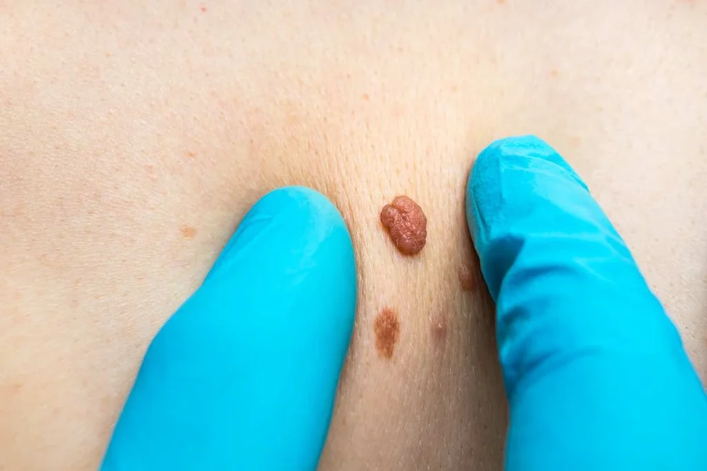 Consultant examining a skin tag West Acton