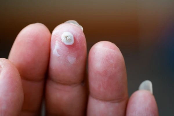 wart on person finger - cryotherapy to treat from LA LIPO West Acton