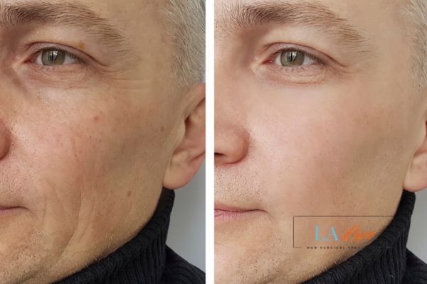 See the amazing results of Morpheus8 Treatment West Acton!