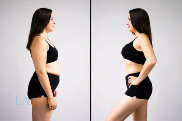 Picture of womans before and after using LA-EMS body sculpting to improve her core strength West Acton