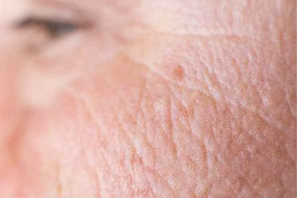 close up picture of a woman's face showing an age spot West Acton