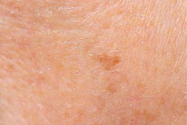 close up picture of age spots West Acton