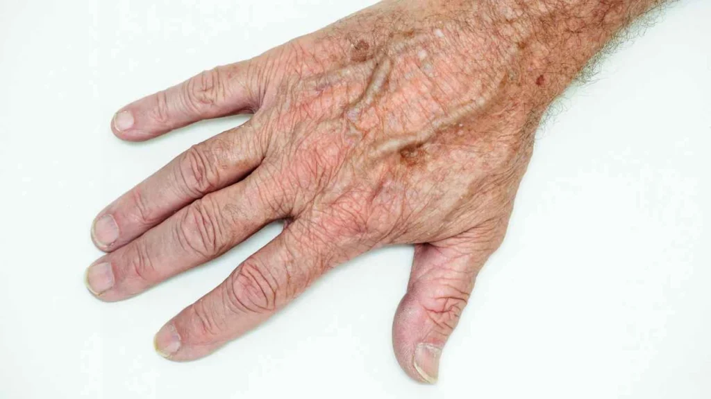 Male hand showing age spot West Acton