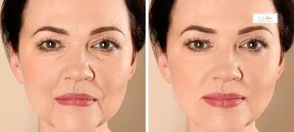 How Long Does It Take to See Results and How Long Do They Last West Acton?